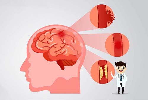  “สมอง” เรื่องที่ต้องรู้ กับความสำคัญของ ‘หลอดเลือดในสมอง’